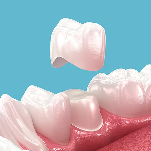 Render de una corona dental blanca sobre un diente tallado.
