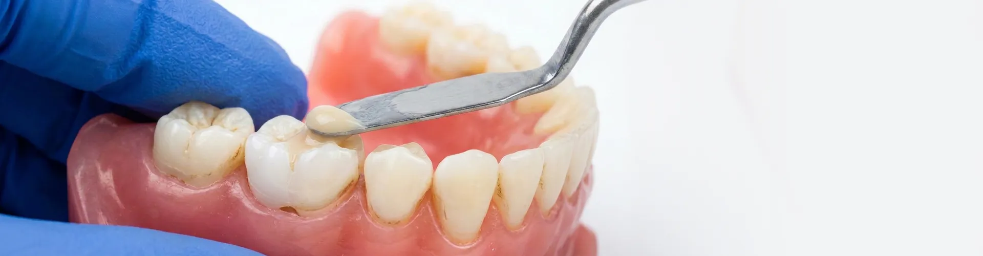 Manos enguantadas colocando material en una cavidad dental de un modelo de mandíbula.