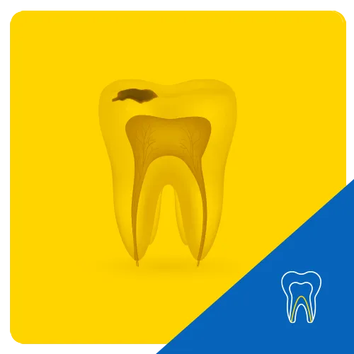 Representación 3D de un diente con raíces expuestas y una caries visible en la parte superior, sobre un fondo amarillo para ilustrar la caries dental.