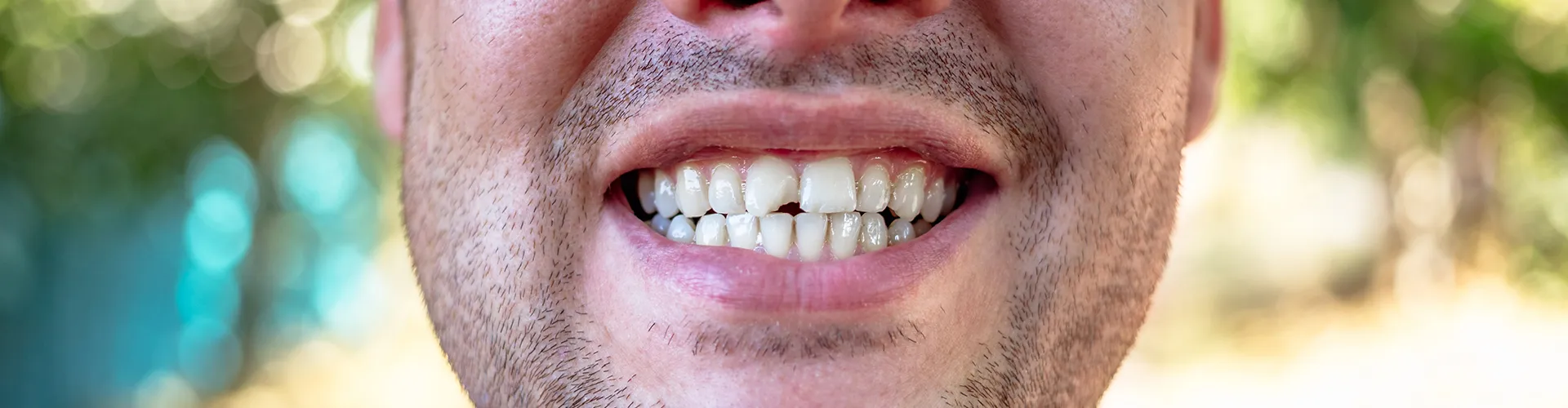 Hombre sonriendo con diente astillado.