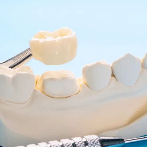 Pinzas colocando una corona sobre un modelo de yeso de una mandíbula.