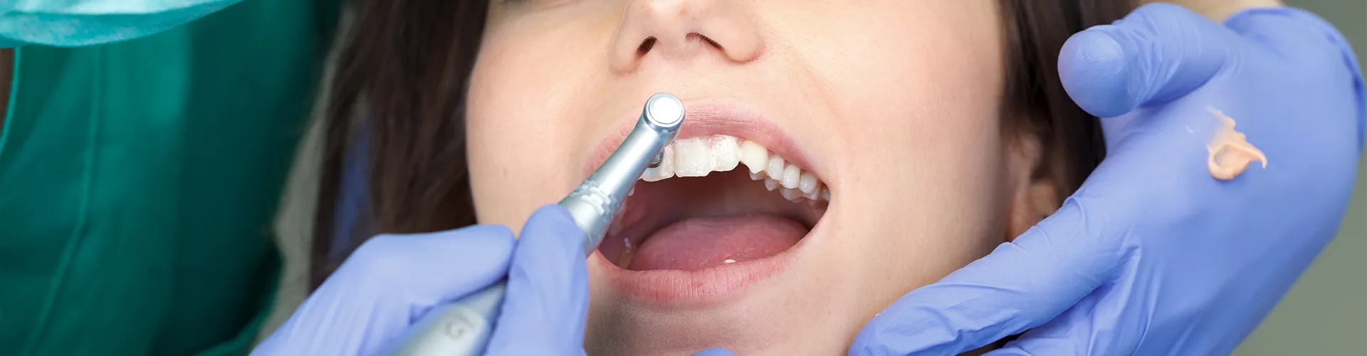 Manos enguantadas usando una herramienta dental para limpiar los dientes de una mujer