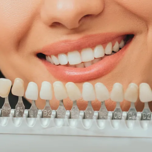 Herramienta de selección de tono dental frente a la sonrisa de una mujer.