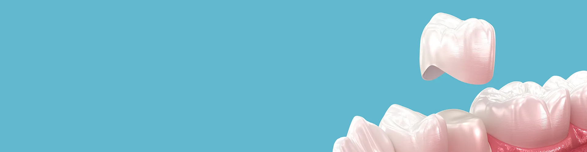 Render de una corona dental blanca sobre un diente tallado.