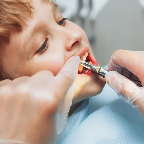 Manos con guantes usando pinzas dentales para extraer un diente de un niño.