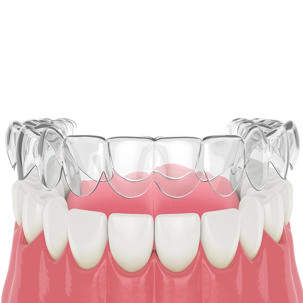 Representación 3D de dientes con alineadores transparentes colocados sobre ellos, sobre un fondo blanco.
