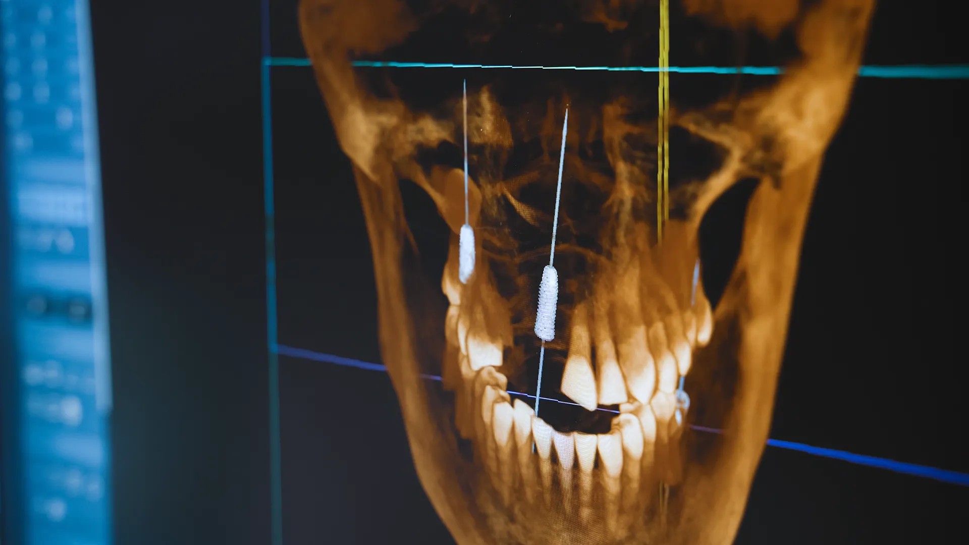 Imagen de radiografía dental mostrando un tornillo dentro de un diente o mandíbula, probablemente parte de un implante dental.