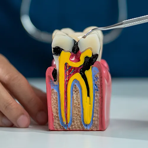 Mano sosteniendo un modelo de un diente con caries.