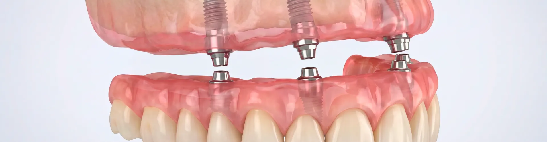 Representación de una prótesis dental siendo fijada a cuatro implantes dentales en la encía superior.