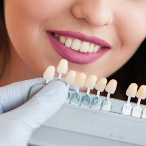 Dentista sosteniendo una guía de tonos para combinar carillas dentales para un cambio de sonrisa del paciente.