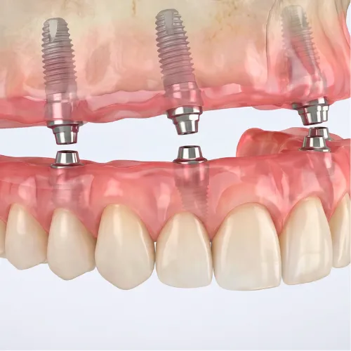 Representación de una prótesis dental siendo fijada a cuatro implantes dentales en la encía superior.
