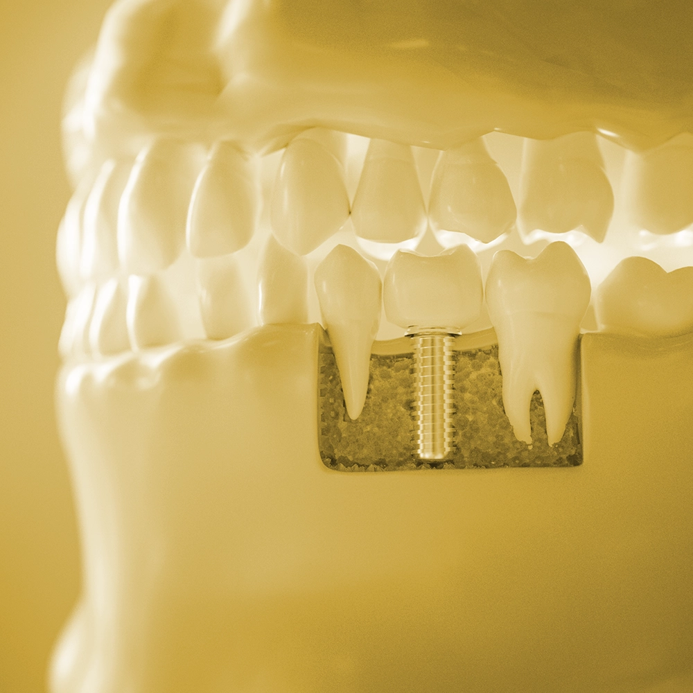 Representación 3D en tonos amarillos de una boca mostrando tres dientes, con el diente del medio como un implante dental.