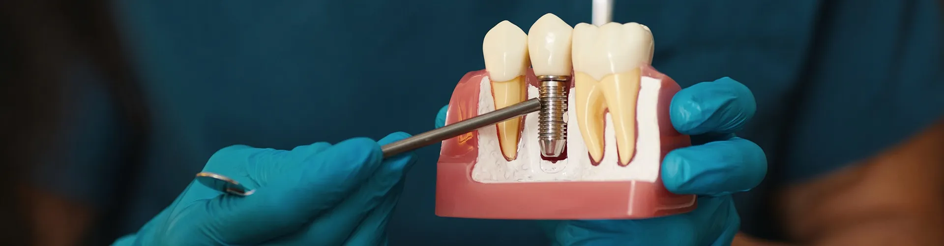 Manos enguantadas sosteniendo un modelo de implante dental.