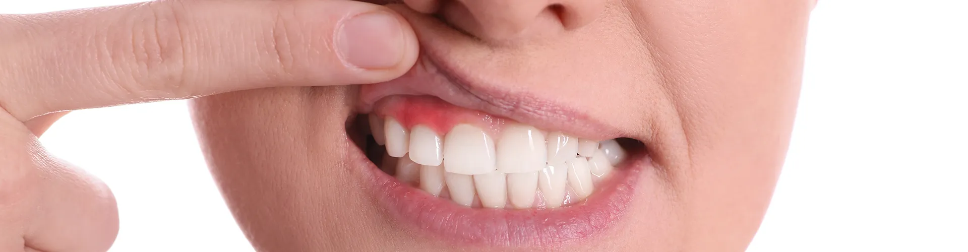 mujer-levantando-el-labio-superior-para-mostrar-encías-inflamadas