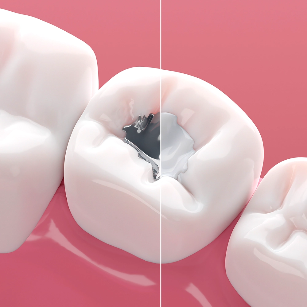Molar 3D con un lado de amalgama y otro de resina, mostrando la diferencia.