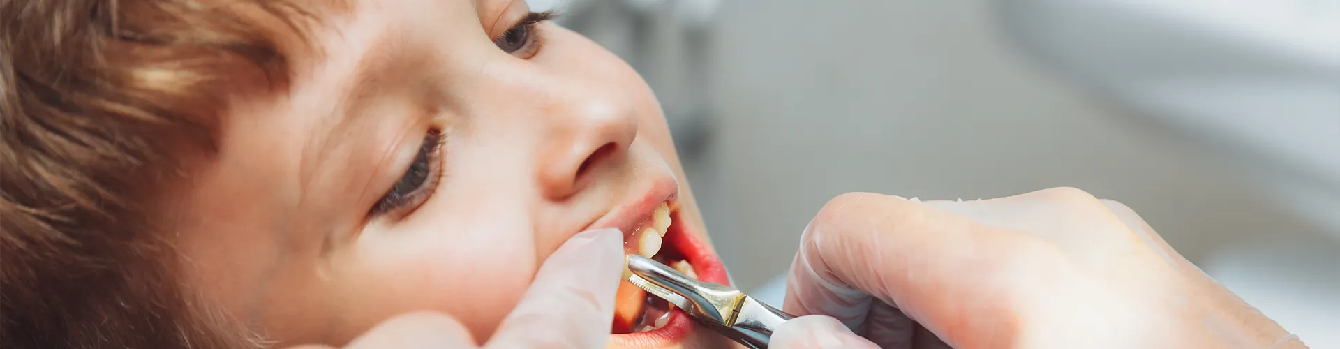 Manos con guantes usando pinzas dentales para extraer un diente de un niño.