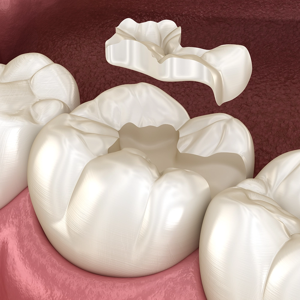 Representación 3D de un molar con empaste de resina.
