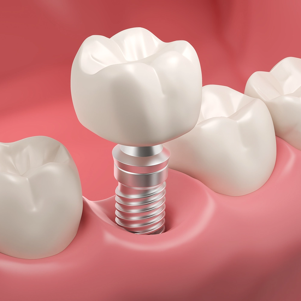 Representación 3D de un implante dental siendo colocado en la encía.