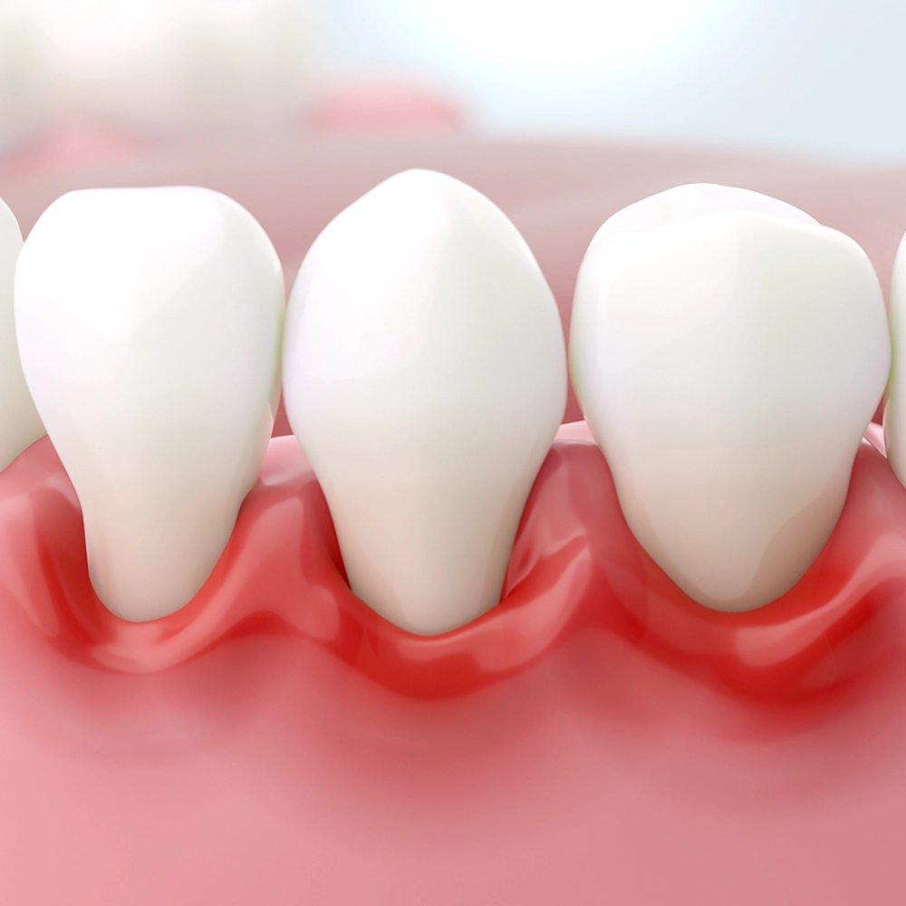 Representación 3D de tres dientes con encías rojas e inflamadas.
