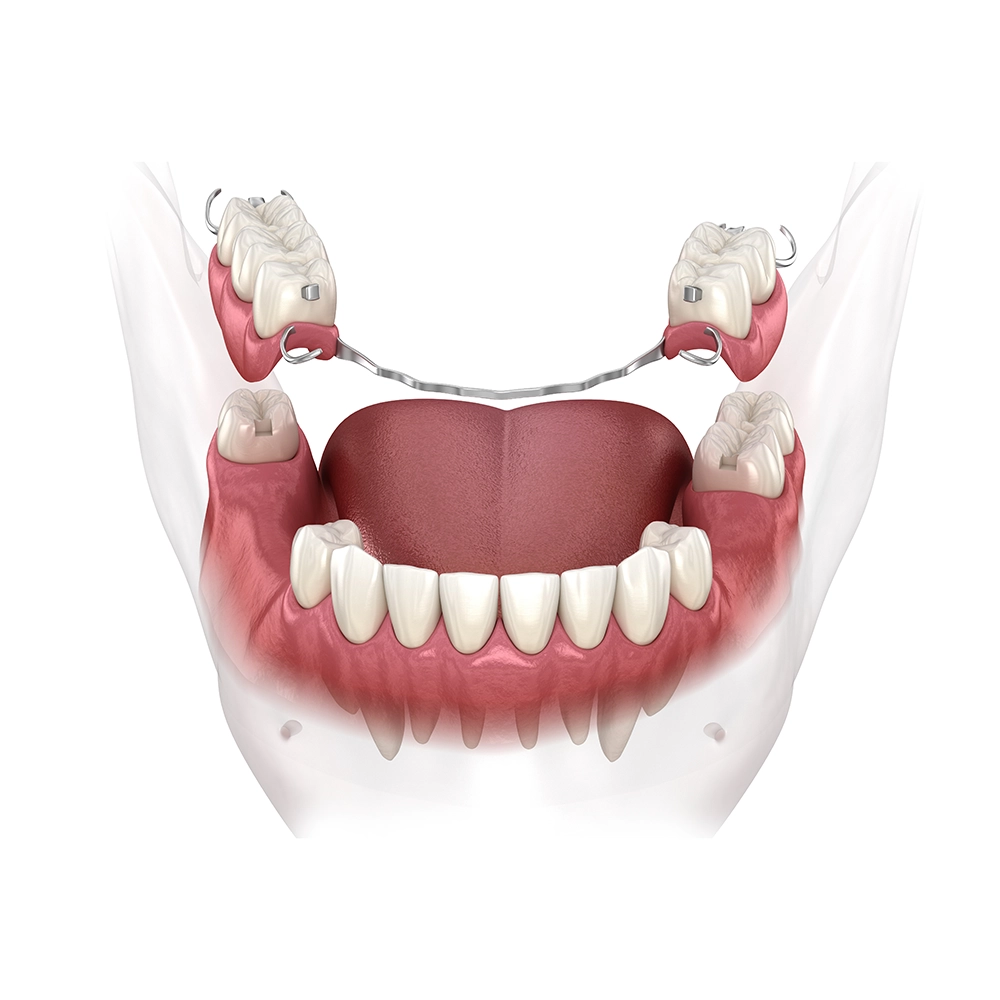 Renderizado 3D de una dentadura parcial para la mandíbula inferior, mostrando cómo se ajusta alrededor de los dientes naturales restantes con ganchos metálicos para un soporte seguro.