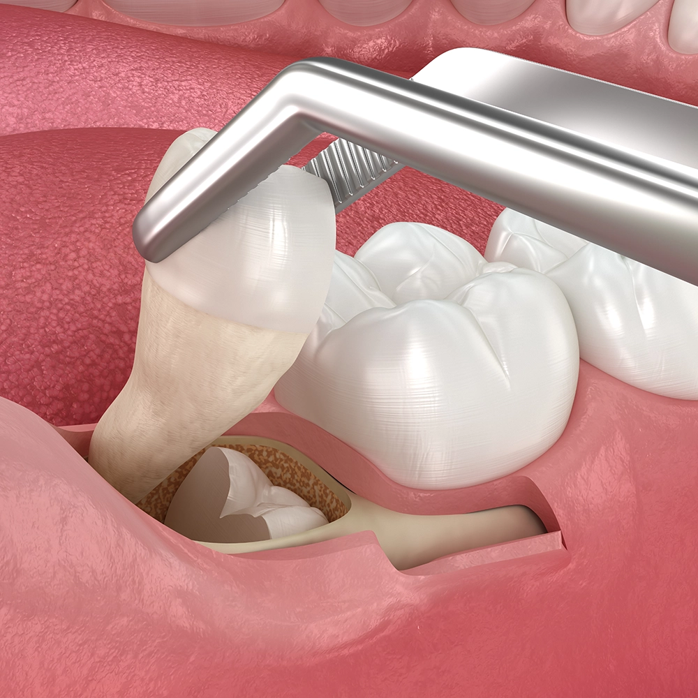 Representación 3D de un fragmento de diente sostenido con pinzas durante una extracción.