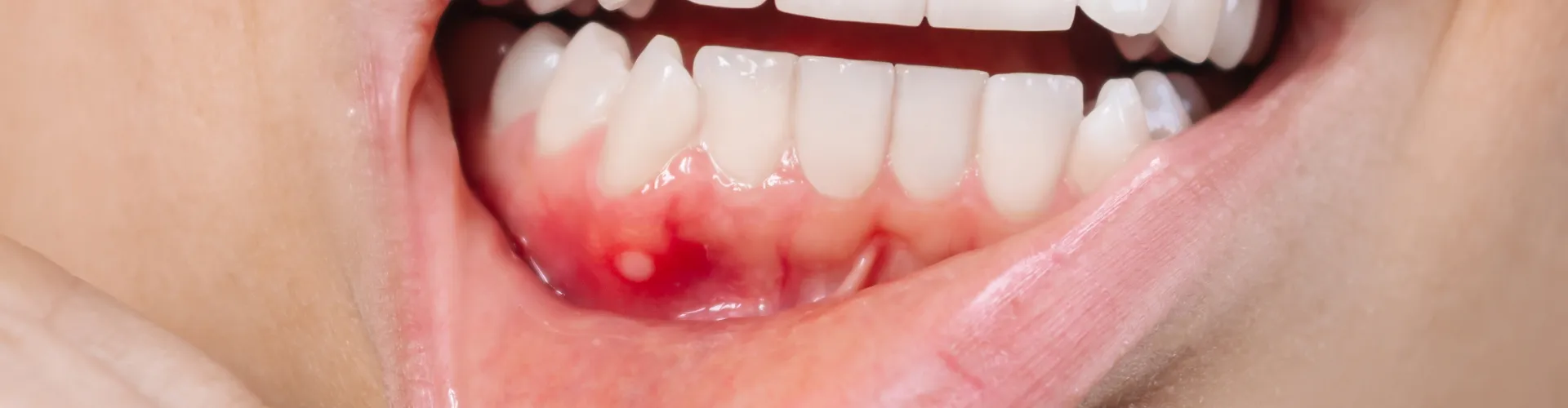 Mujer bajando el labio inferior para mostrar una encía inflamada.
