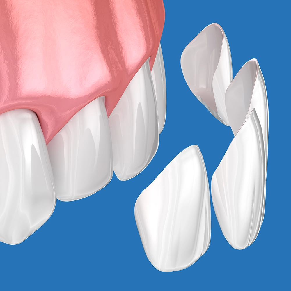 Representación 3D de dientes con carillas en los dientes frontales sobre un fondo azul.