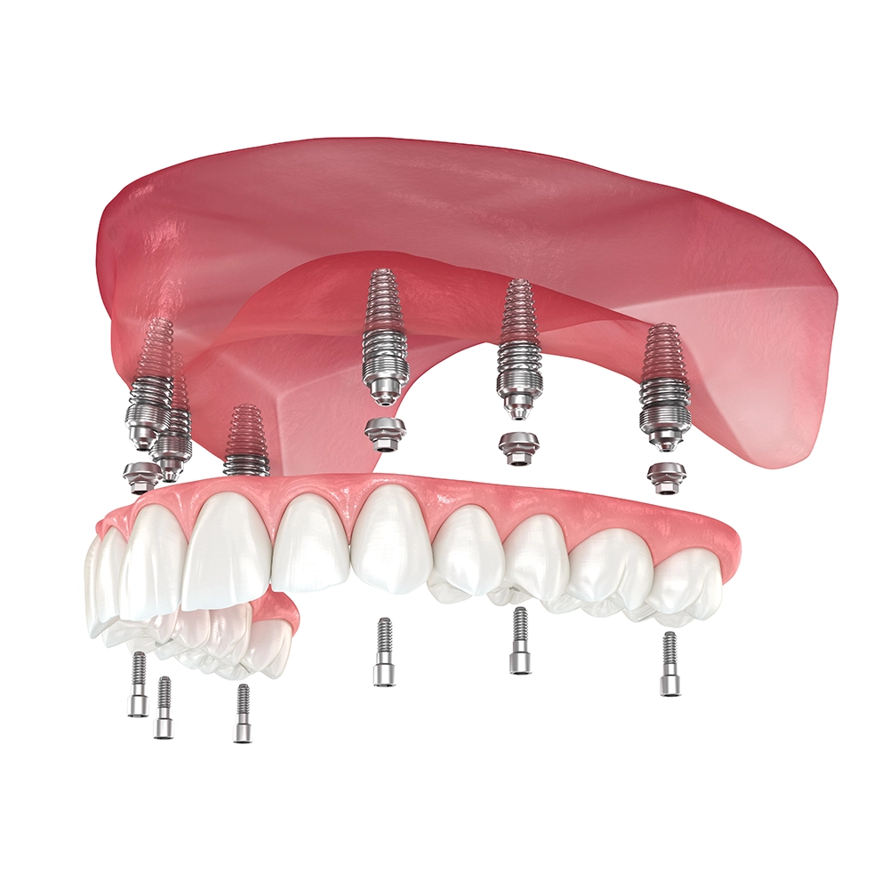 Renderizado 3D de un sistema de dentadura soportada por implantes, mostrando implantes dentales anclando de manera segura una dentadura superior en su lugar, destacando la estabilidad y el soporte.