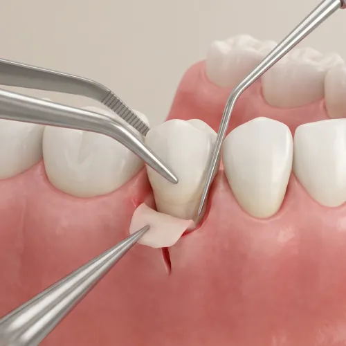 Imagen dental que muestra opciones de tratamiento para la recesión de encías como el injerto.