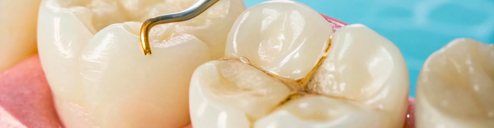 Modelo de dientes con caries.