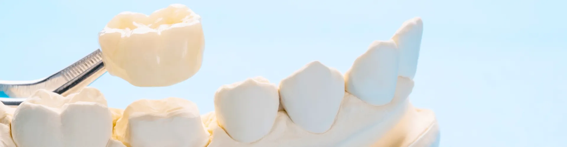 Pinzas colocando una corona sobre un modelo de yeso de una mandíbula.