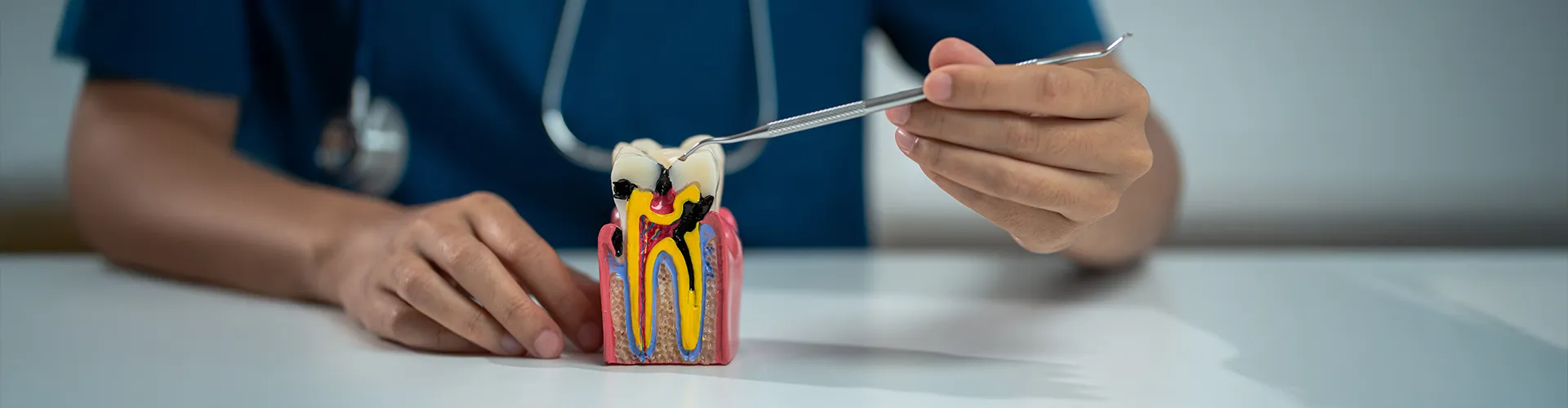 Mano sosteniendo un modelo de un diente con caries.