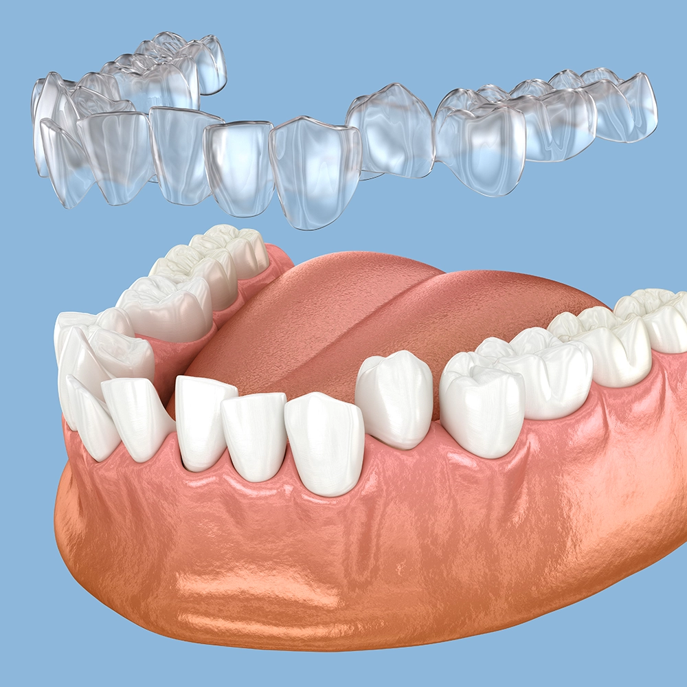Dientes inferiores 3D con alineador transparente (Invisalign) flotando sobre un fondo azulado.