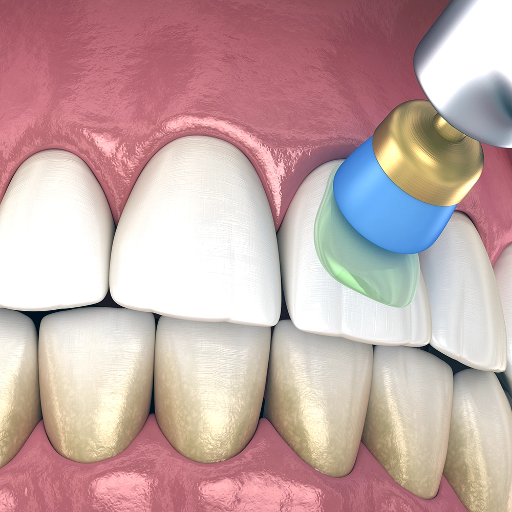 Visualización 3D de un procedimiento de pulido dental en los dientes frontales inferiores, enfatizando la precisión y efectividad de la limpieza dental.