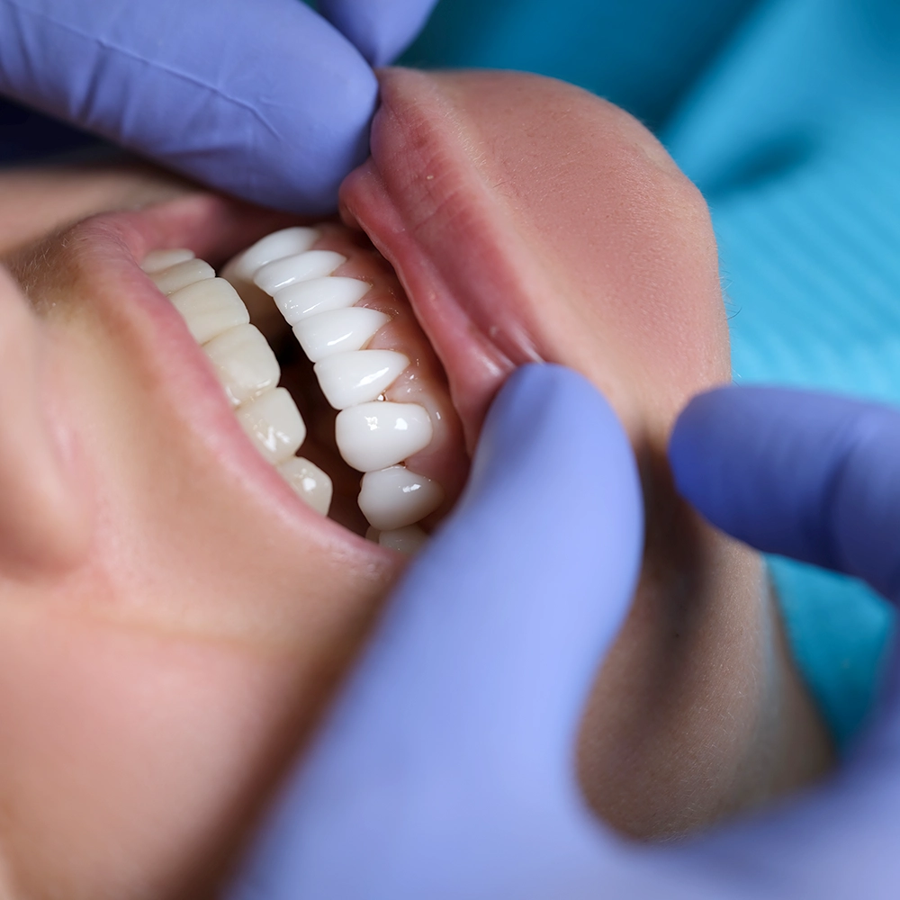 Primer plano de una sonrisa con manos con guantes azules levantando suavemente el labio inferior para mostrar los dientes.