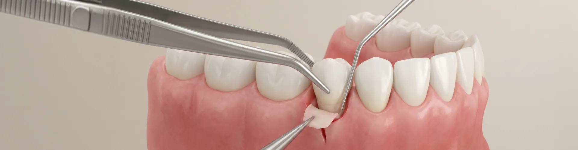 Imagen dental que muestra opciones de tratamiento para la recesión de encías como el injerto.
