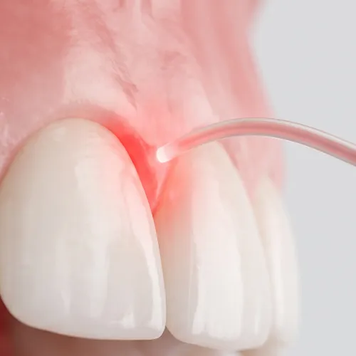 Primer plano de un contorneado cosmético de encías usando un láser dental para remodelar la línea de las encías alrededor de los dientes frontales.