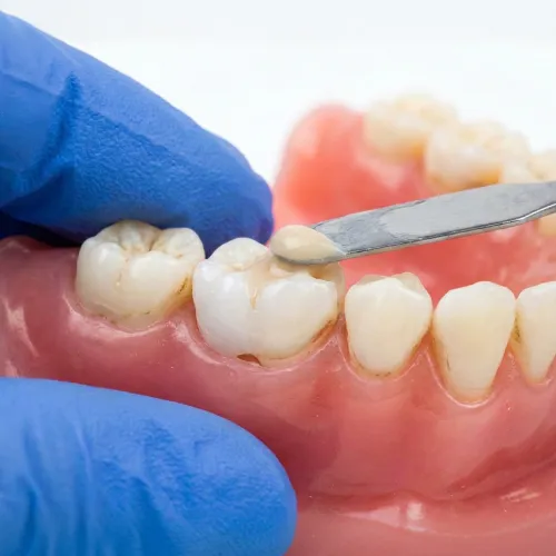 Manos enguantadas colocando material en una cavidad dental de un modelo de mandíbula.