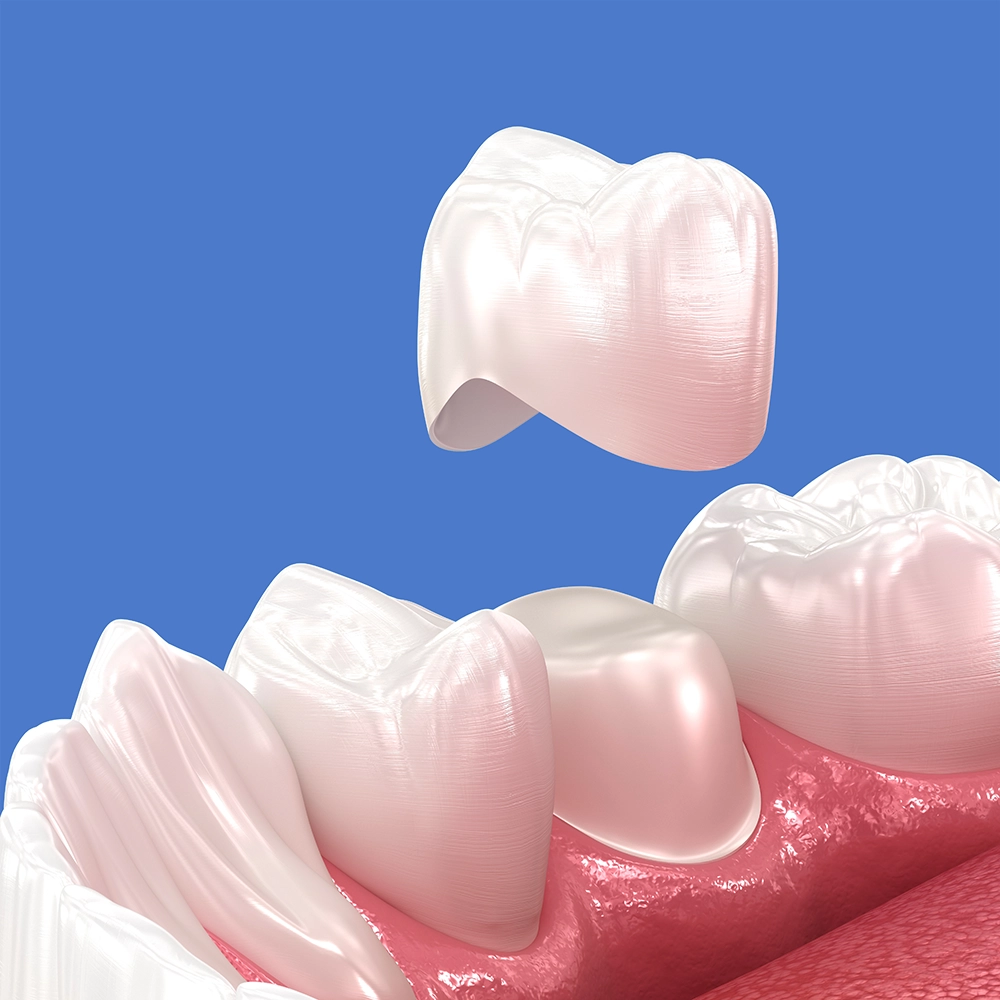 Representación 3D de una corona dental siendo colocada sobre un diente.