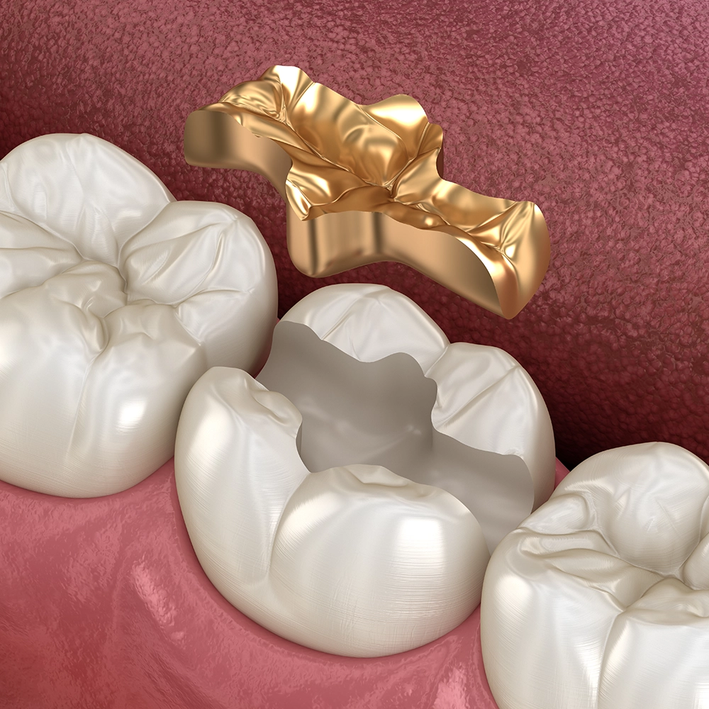 Representación 3D de tres molares con empastes de oro.