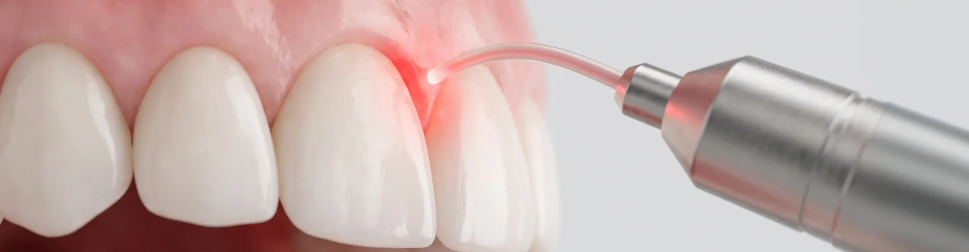 Primer plano de un contorneado cosmético de encías usando un láser dental para remodelar la línea de las encías alrededor de los dientes frontales.
